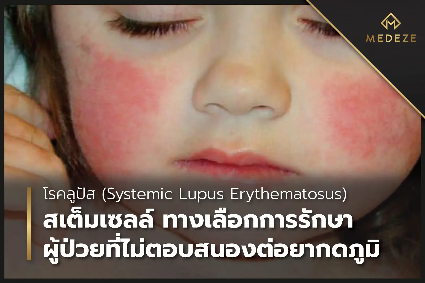 Systemic lupus erythematosus