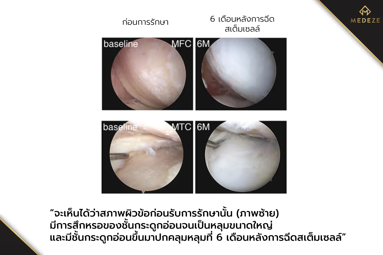 ฉีดสเต็มเซลล์