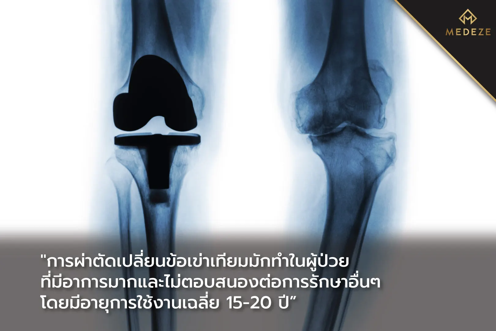 โรคข้อเข่าเสื่อม