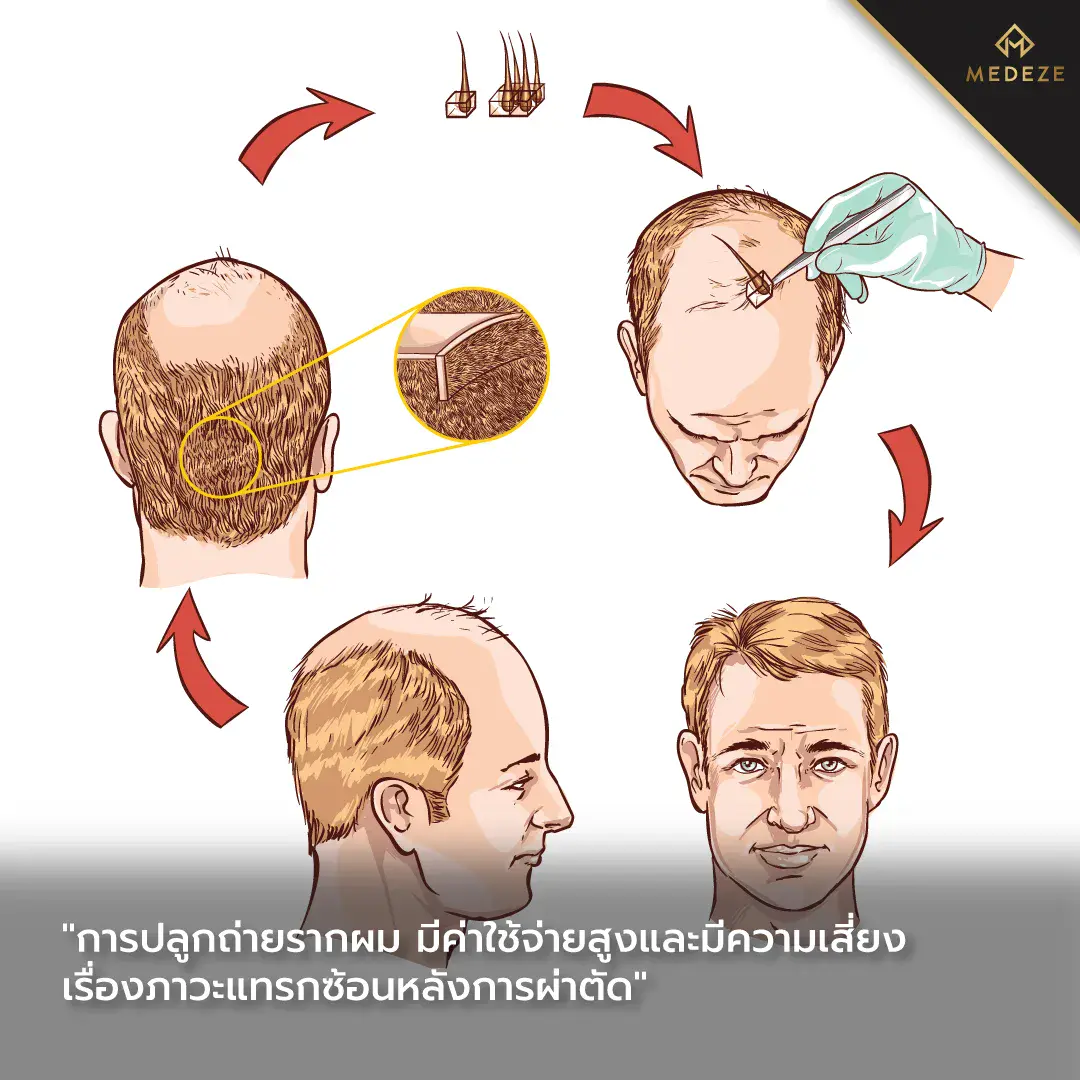 การปลูกถ่ายรากผม